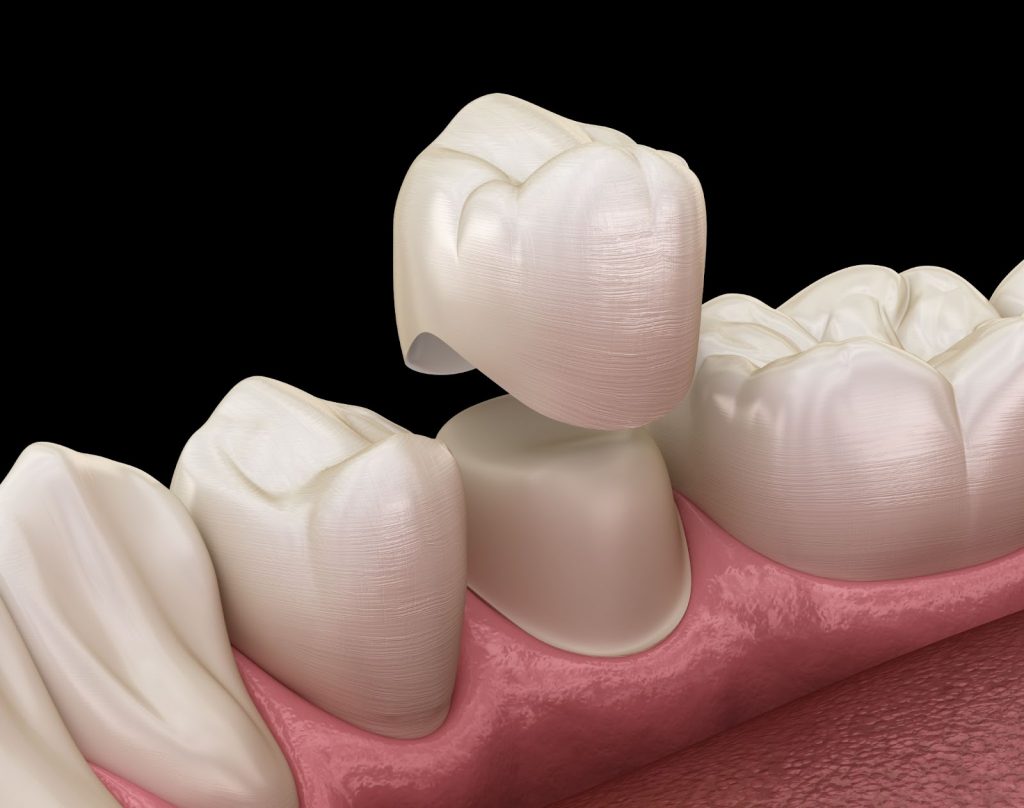 3 Things Dental Crowns Can Fix