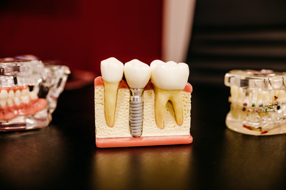 How Dental Implants Could Restore Your Beautiful Smile