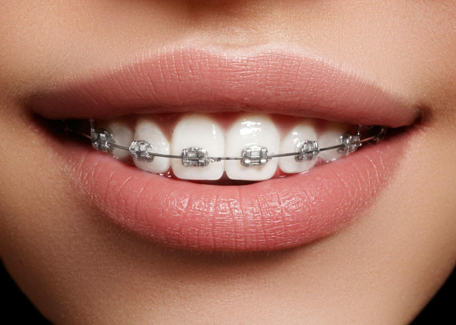Insignia Braces Benefits, Process and What to Expect